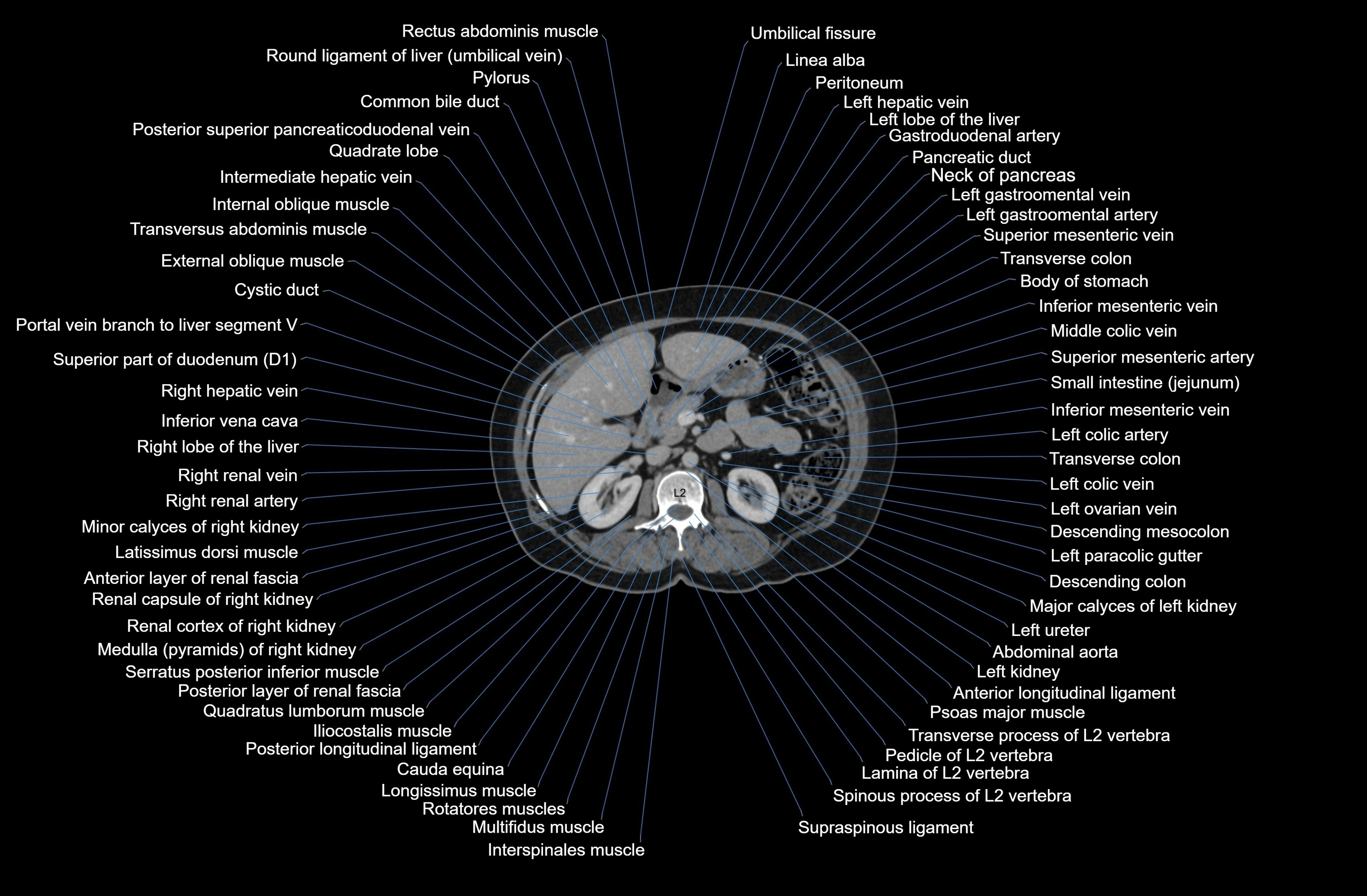 CT Abdomen axial cross sectional anatomy labelled radiology image-00034.webp